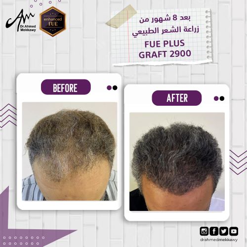 أفضل مكان لزراعة الشعر في مصر